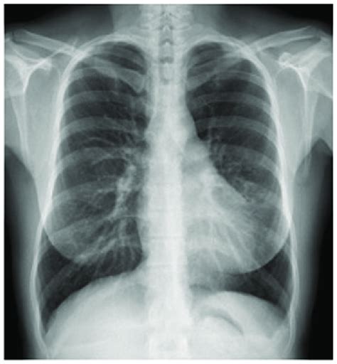 can chest xray show asthma